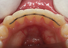 Brushing Your Braces