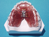 Sagittal Appliance