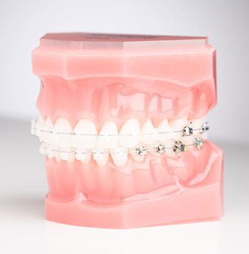 Ceramic Braces photo