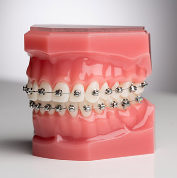 Self-Ligating Metal Braces