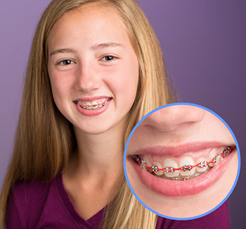 T Braces photo