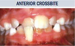 Anterior Crossbite
