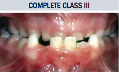 Complete Class III