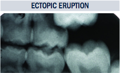 Ectopic Eruption