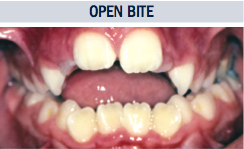OpenBite