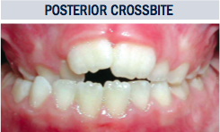 Posterior Crossbite