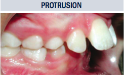 Protrusion